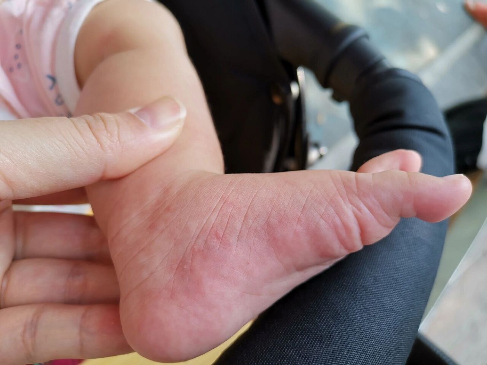 突然发现宝宝手脚有红疹,当时也很着急,怕是手足口