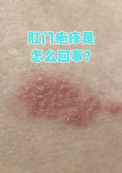 肛门疱疹就是生殖器疱疹,它是由病毒感染引起的,和不洁性生活也有