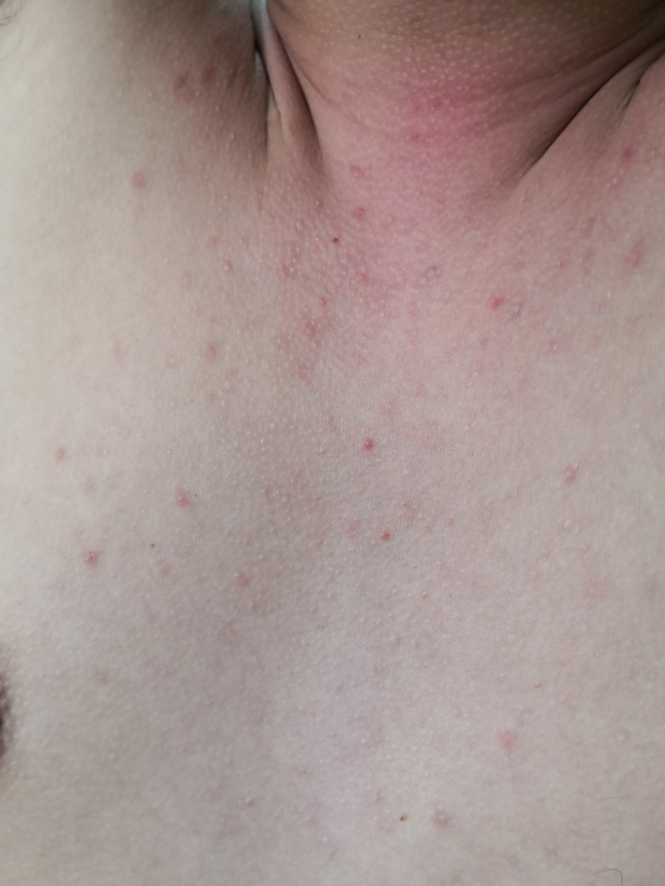 颈周及前胸后背散发的毛囊炎性丘疹脓疱.