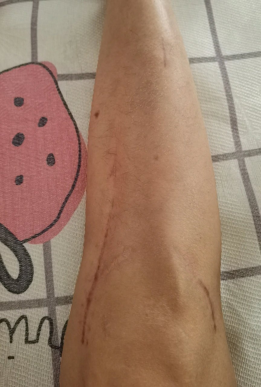 胫骨平台粉碎性骨折术后135天 图一:伤口恢复情况还不错,就是腿毛长得