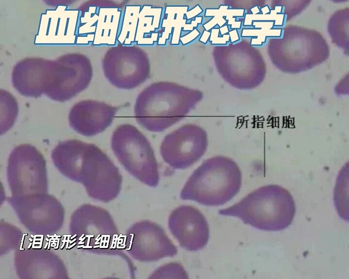 泪滴状红细胞图片