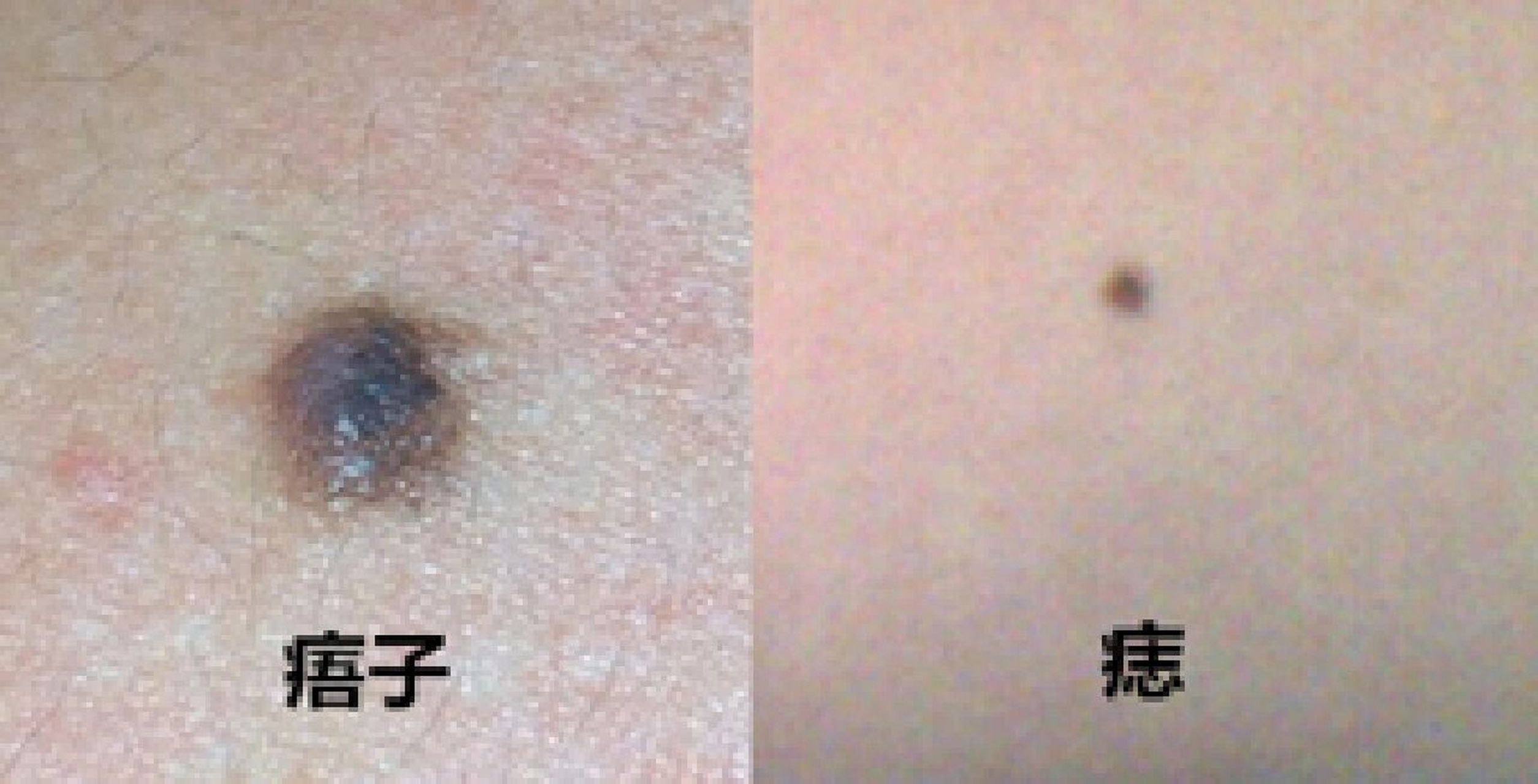 痦子和痣是一样的吗?