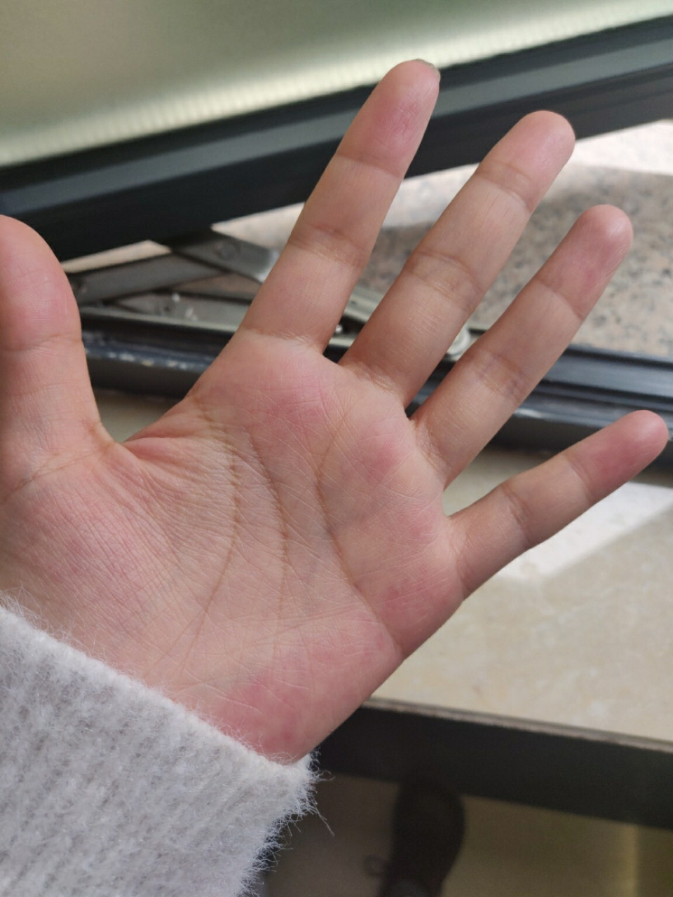 看到肝掌的描述,感觉自己的手完全符合而且从小就这样.