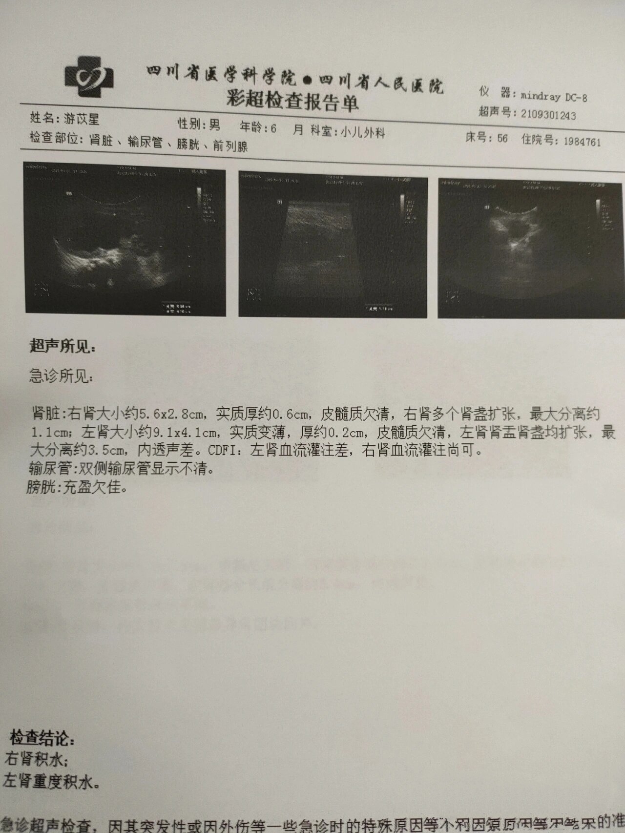 宝宝双侧重度肾积水术后一年