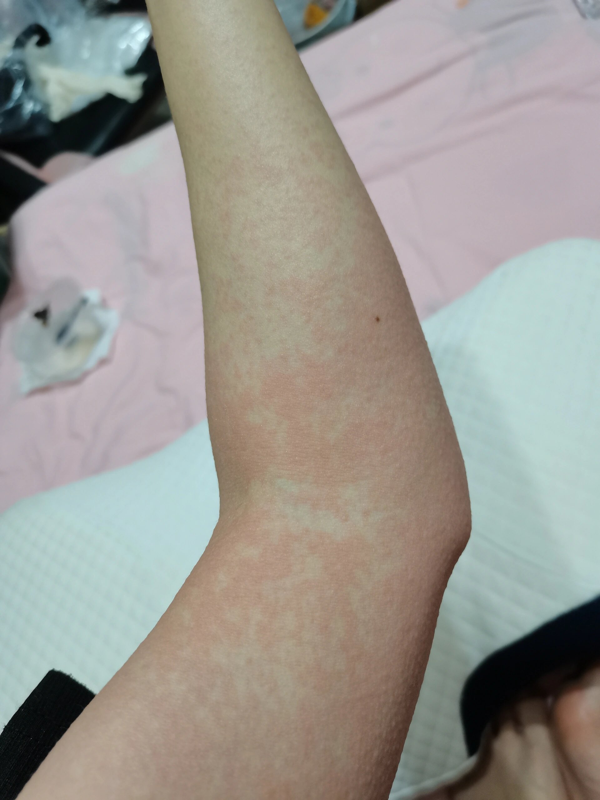 发烧阳后,全身红疹