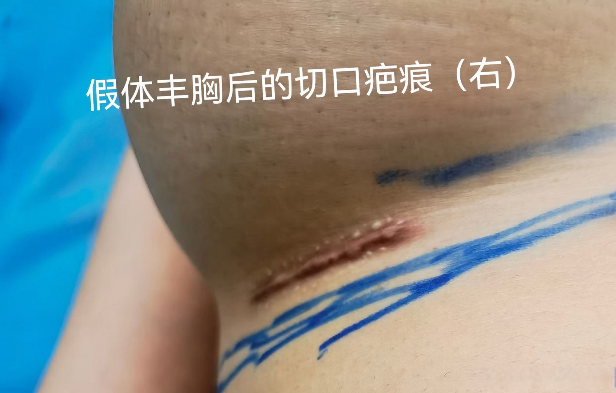 在假体丰胸术三个常见切口入路中,乳房下皱襞入路以前是不常用的,近几