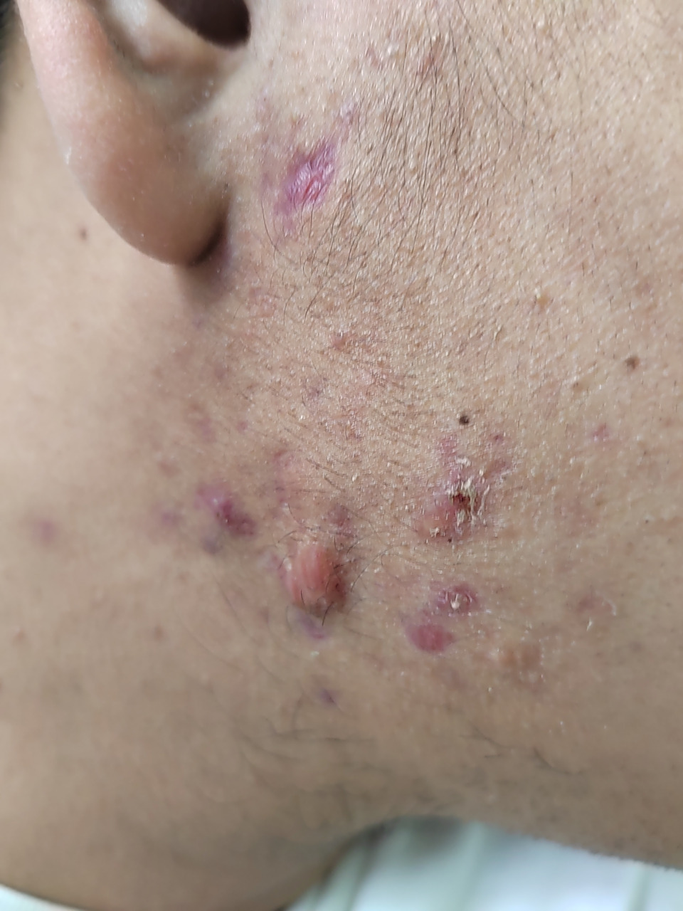 面部痤疮疤痕瘢痕疙瘩.#解决皮肤问题专注皮肤美容##瘢痕疙瘩