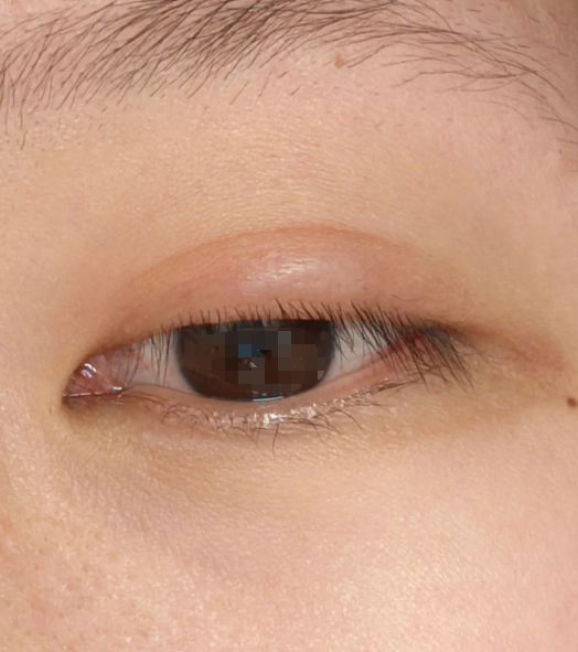 早期麦粒肿会出现典型的症状:眼皮局部红肿,摸起来会痛,有些人还会