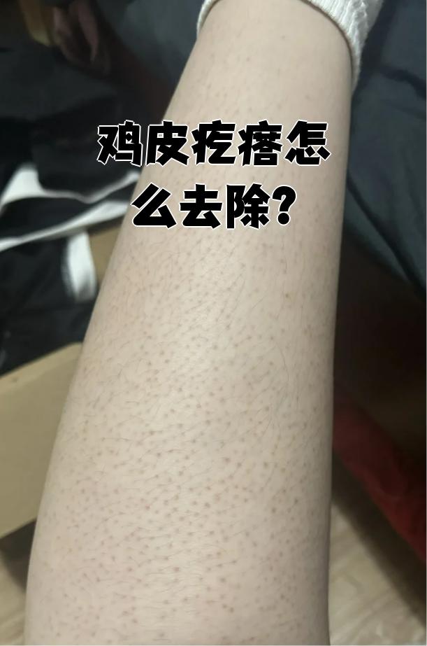 鸡皮一样的小疹子图片百科在线