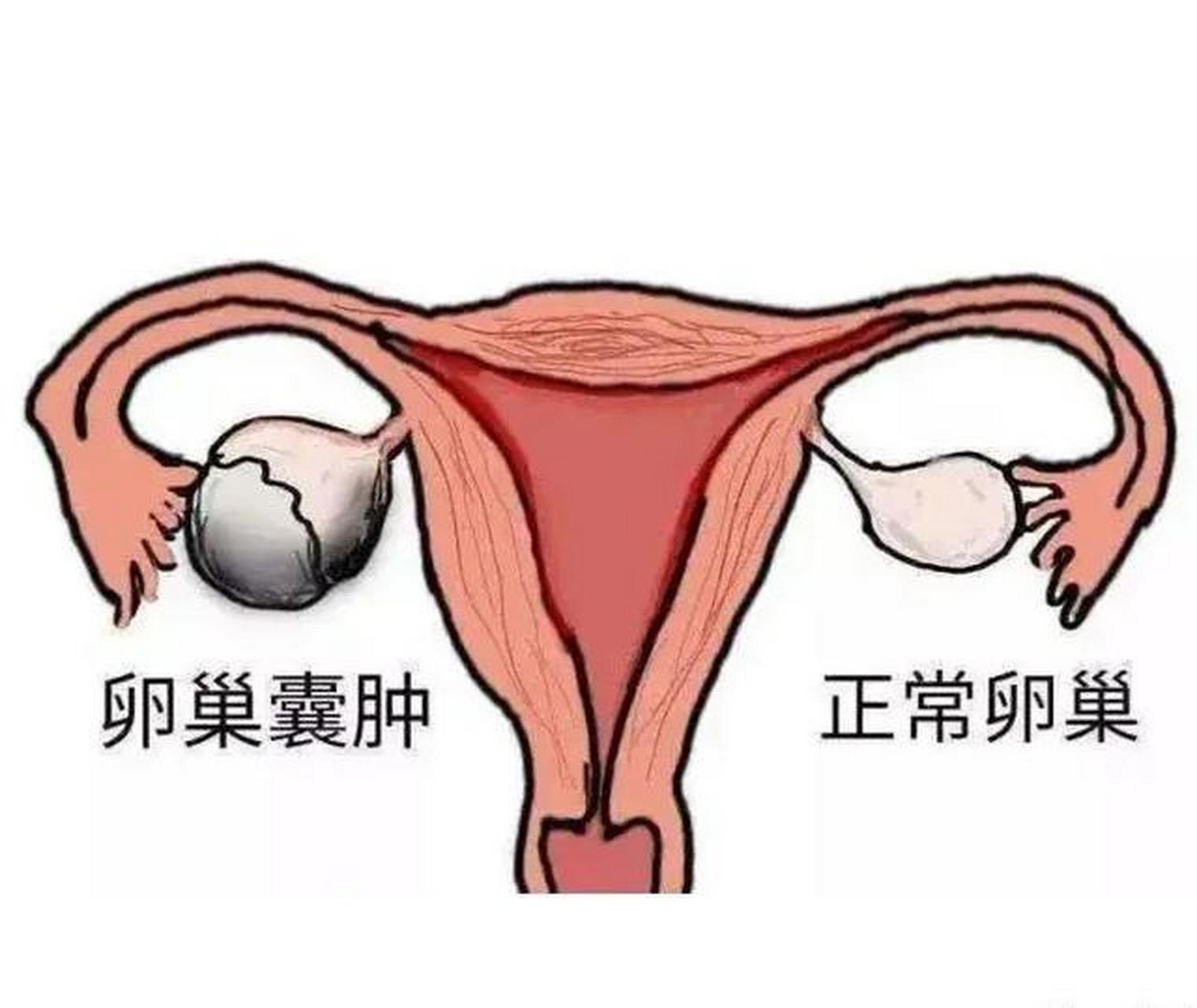 卵巢肿物分为生理性囊肿,良性肿瘤和恶性肿瘤.