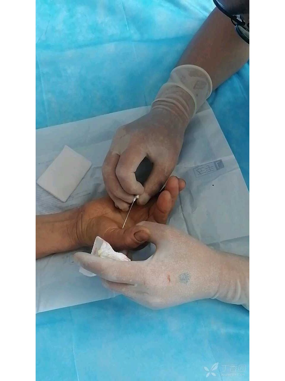 小针刀治疗腱鞘炎,一次小针刀即愈