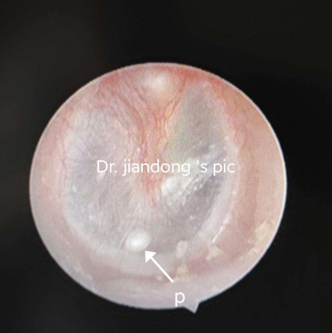 白色的上皮珠p这是愈合时上皮有内翻导致的也是胆脂瘤一类的疾病需要