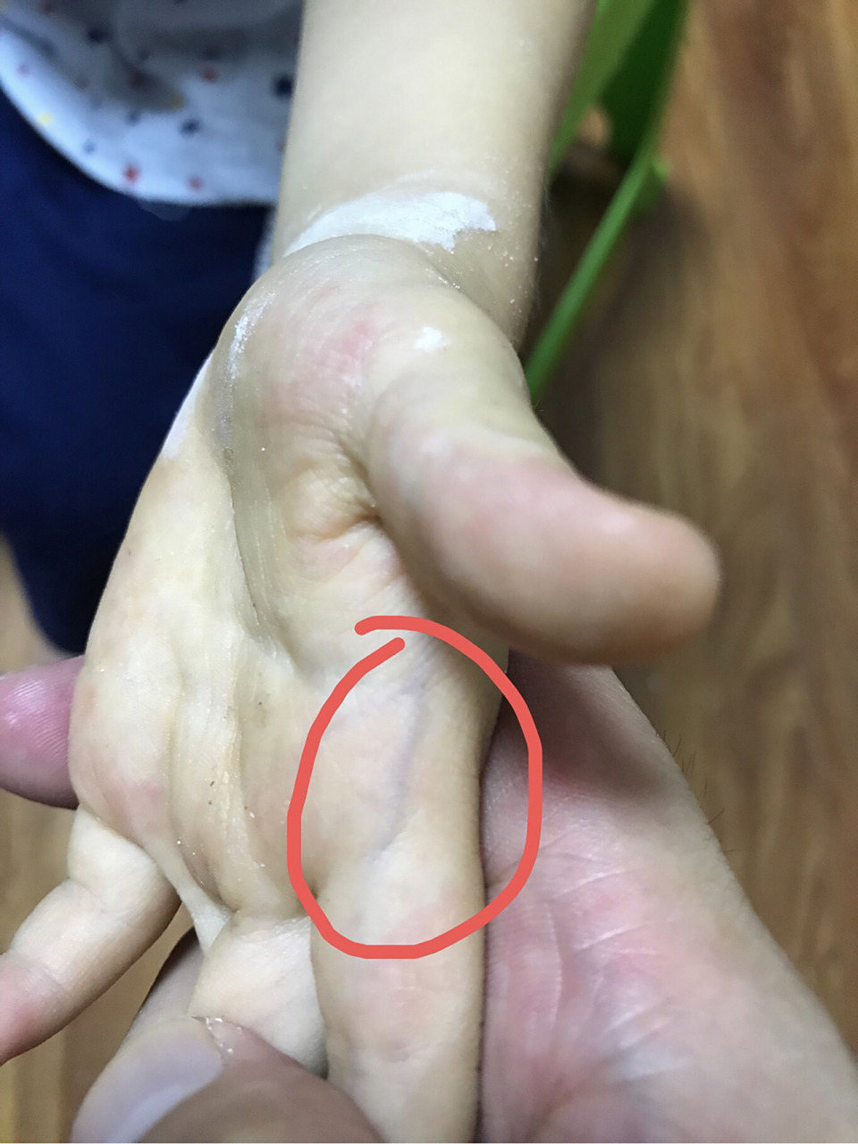 小儿指纹色紫红,家长要当心 小儿指纹的变化可以反映儿童的虚实寒热.