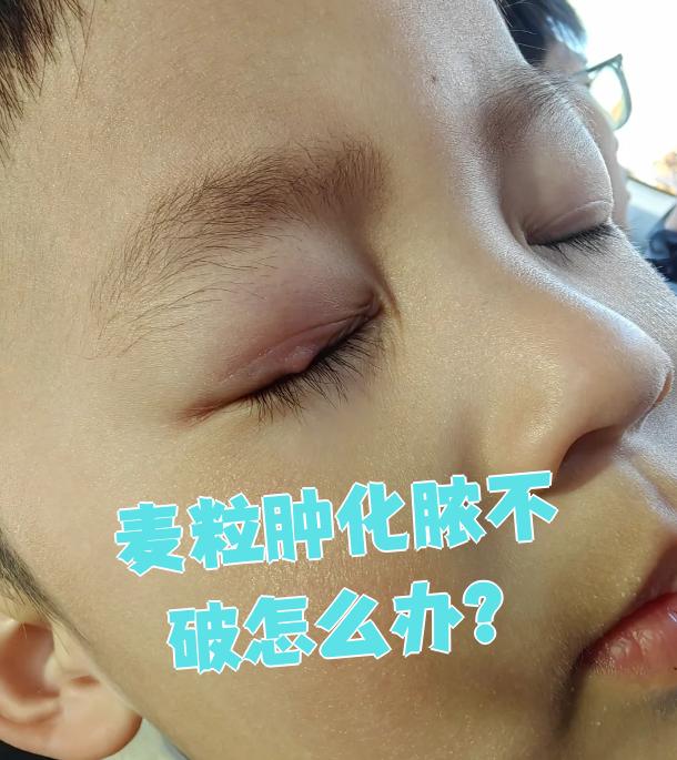 麦粒肿化脓不破怎么办?