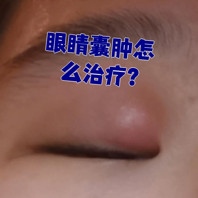 眼睛囊肿常见类型包括霰粒肿,麦粒肿和结膜囊肿,治疗方法要根据惧体