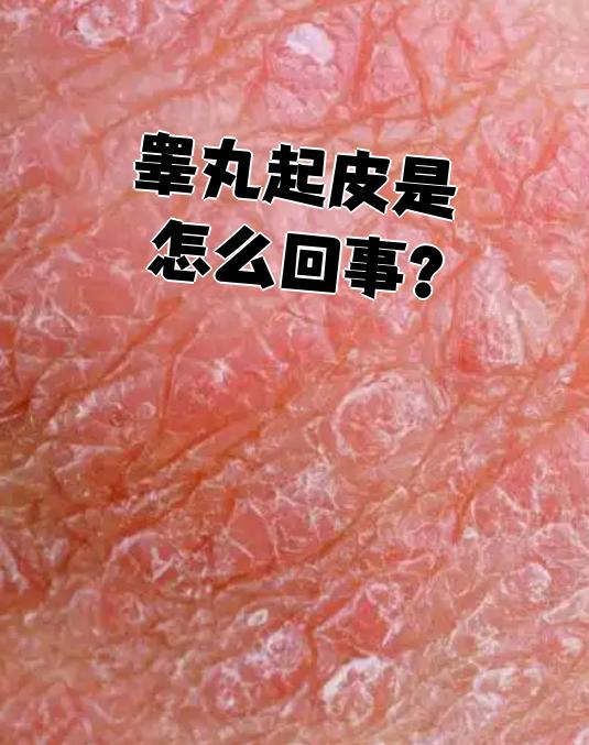 阴囊皮炎早期主要表现为瘙痒,患者会频繁抓挠患处,可能导致皮肤变厚