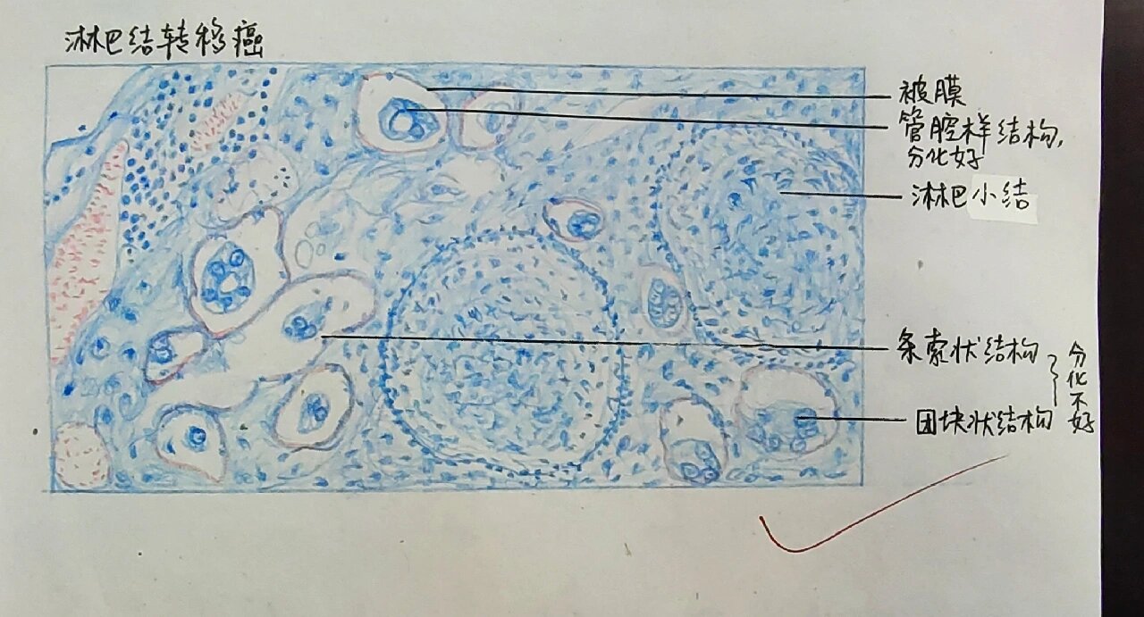 病理学实验绘图——淋巴结转移癌