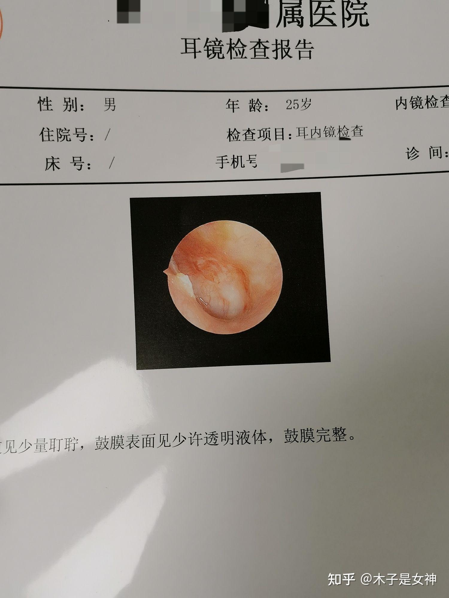 鼓膜上有白色覆盖物图片