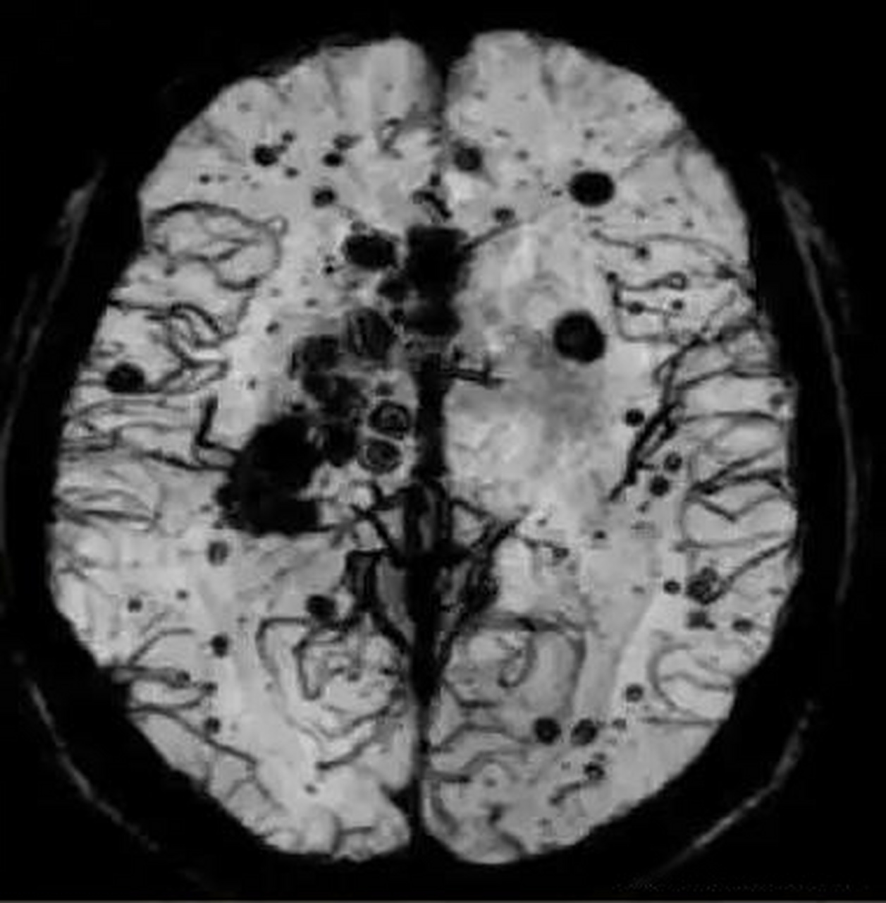 1,脑淀粉样变性又称淀粉样脑血管病,属于一种常见的脑血管病.