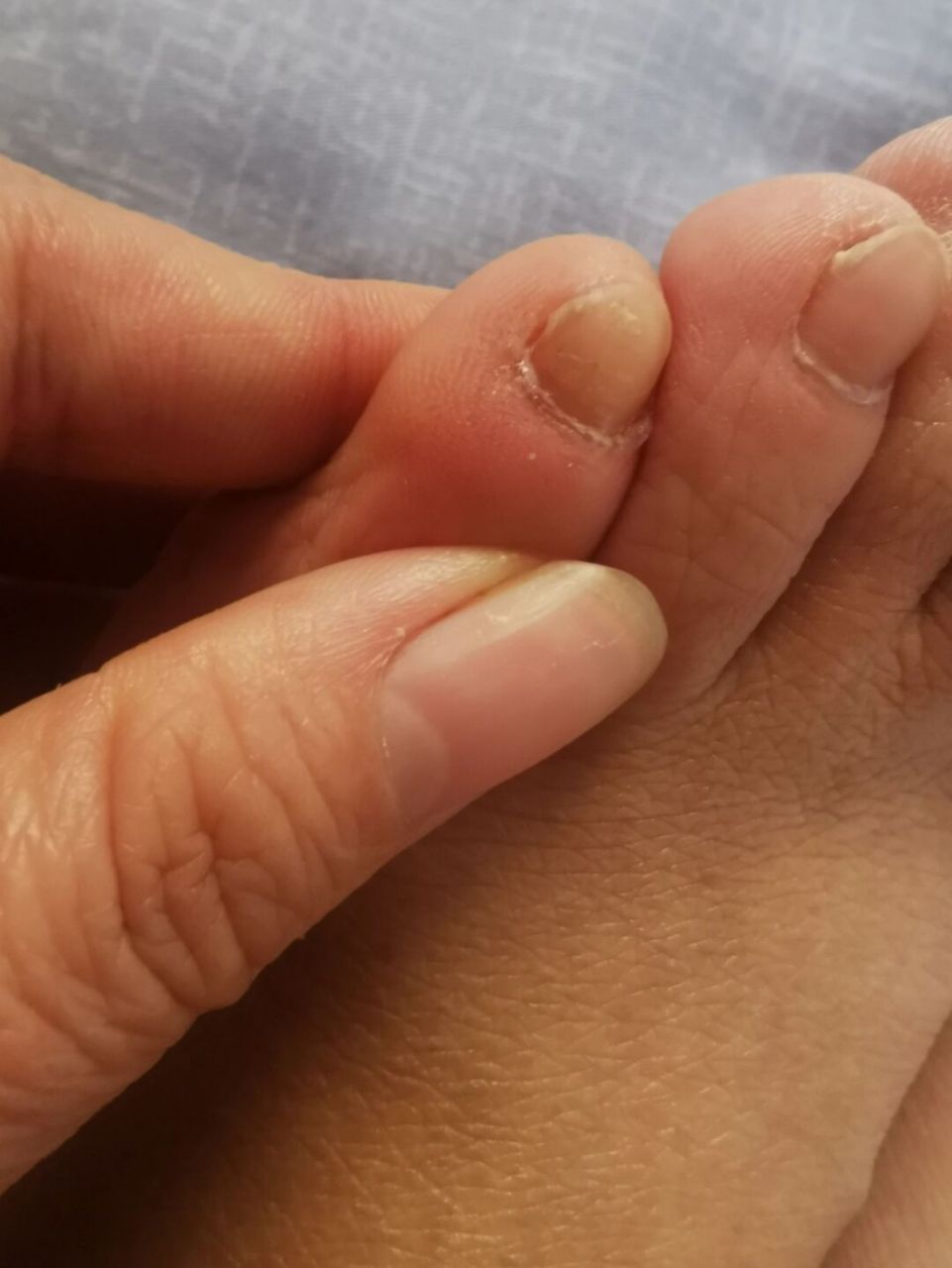 小时候小脚趾的趾甲是两个的,举个爪爪!