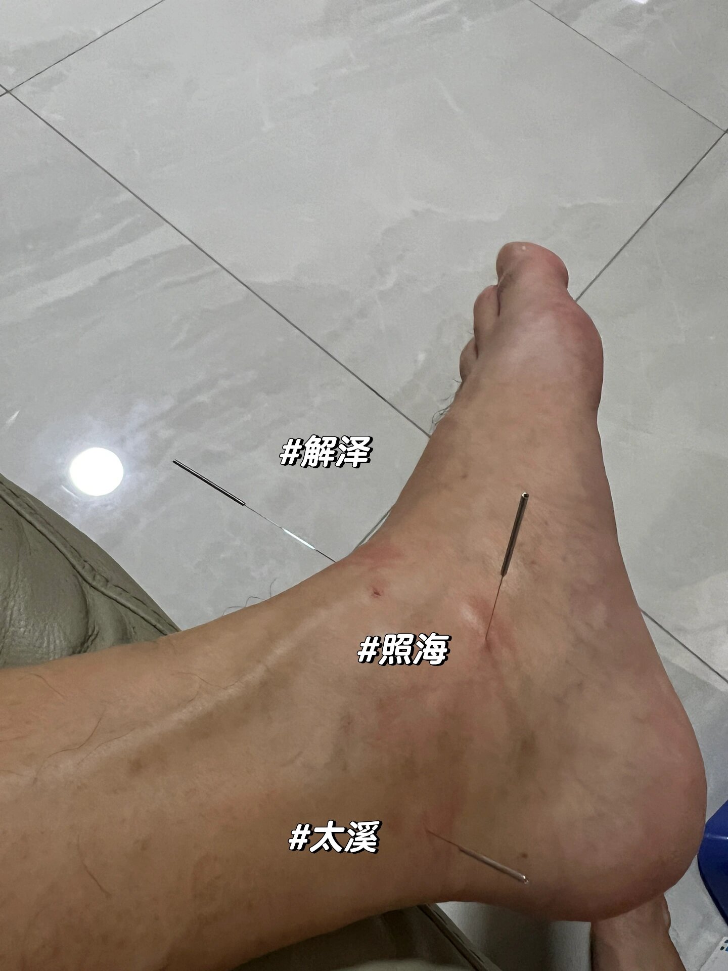 董氏和传统穴-侧三里,侧下三里,阳池,养老