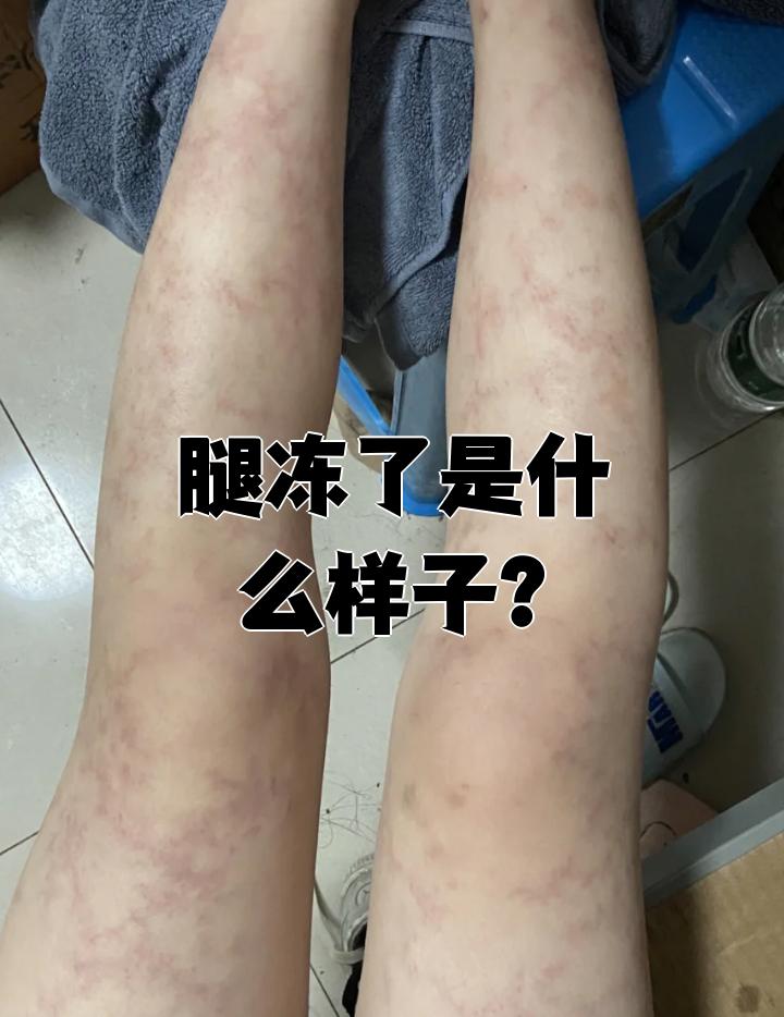 腿冻了就是腿部出现冻疮,这是皮肤在寒冷环境下发生的炎症反应