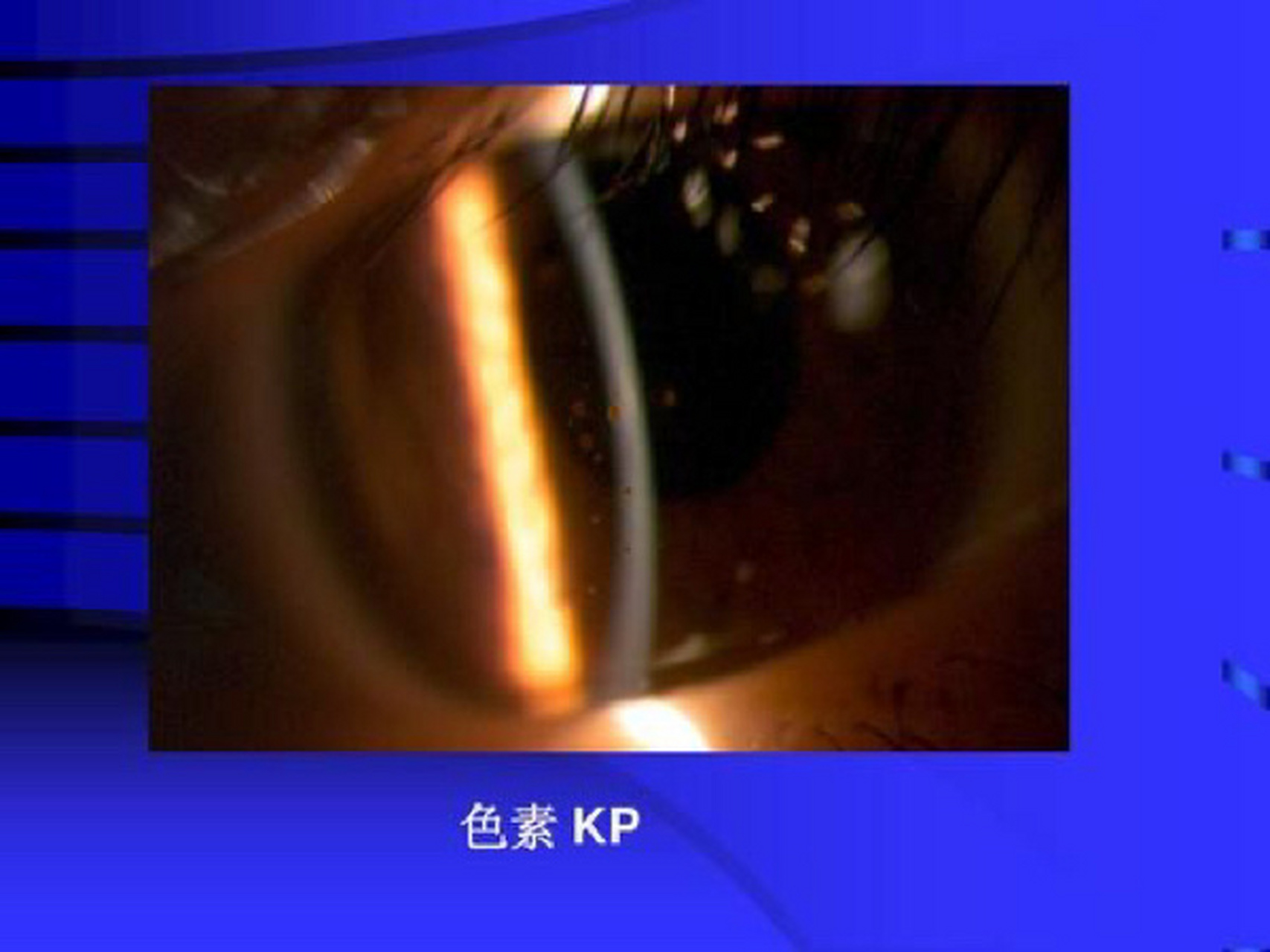 什么是kp kp指角膜后的沉着物,它主要见于眼部的炎症.
