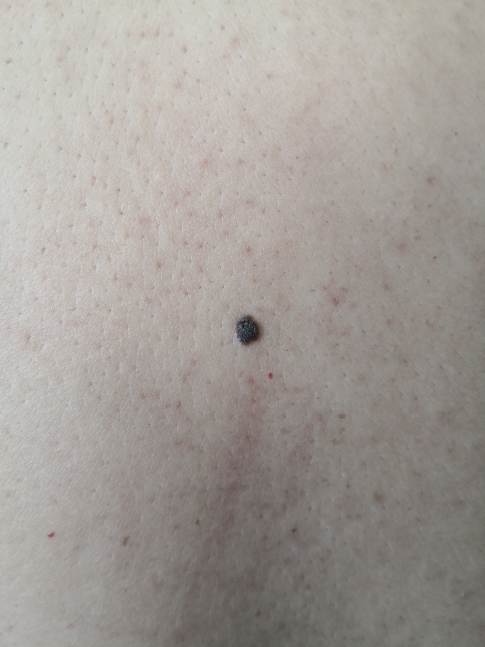 要与色素痣鉴别诊断.#色素痣##脂溢性角化##老年斑