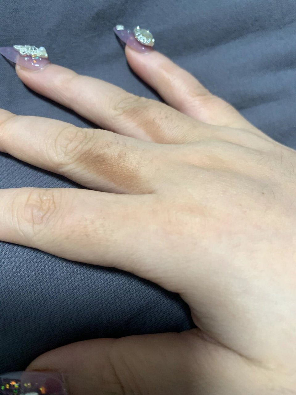 手指缝突然变黑 有人看得出来怎么回事吗 已经一周了 还没白回去 好烦