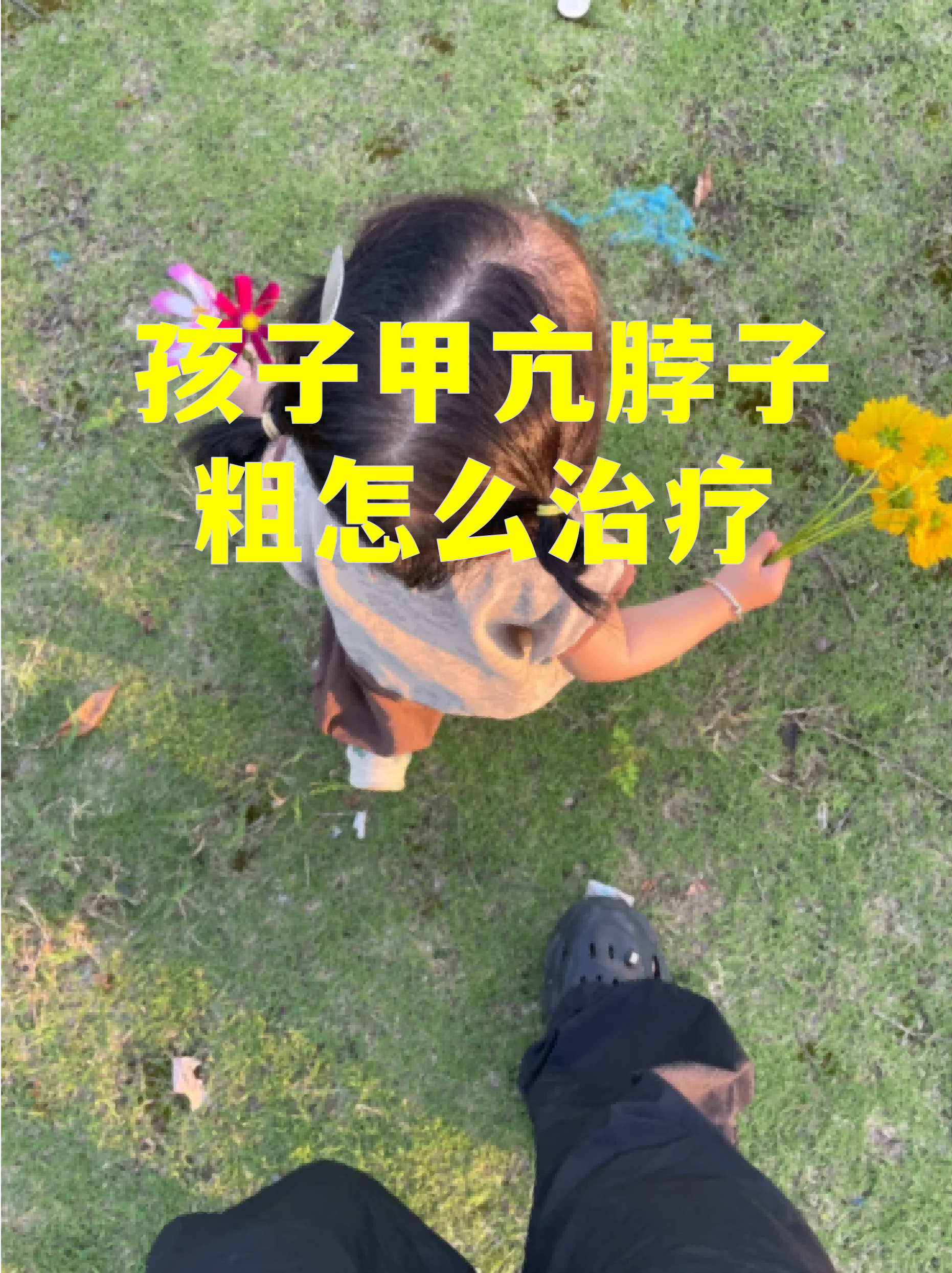 孩子甲亢脖子粗怎么治疗