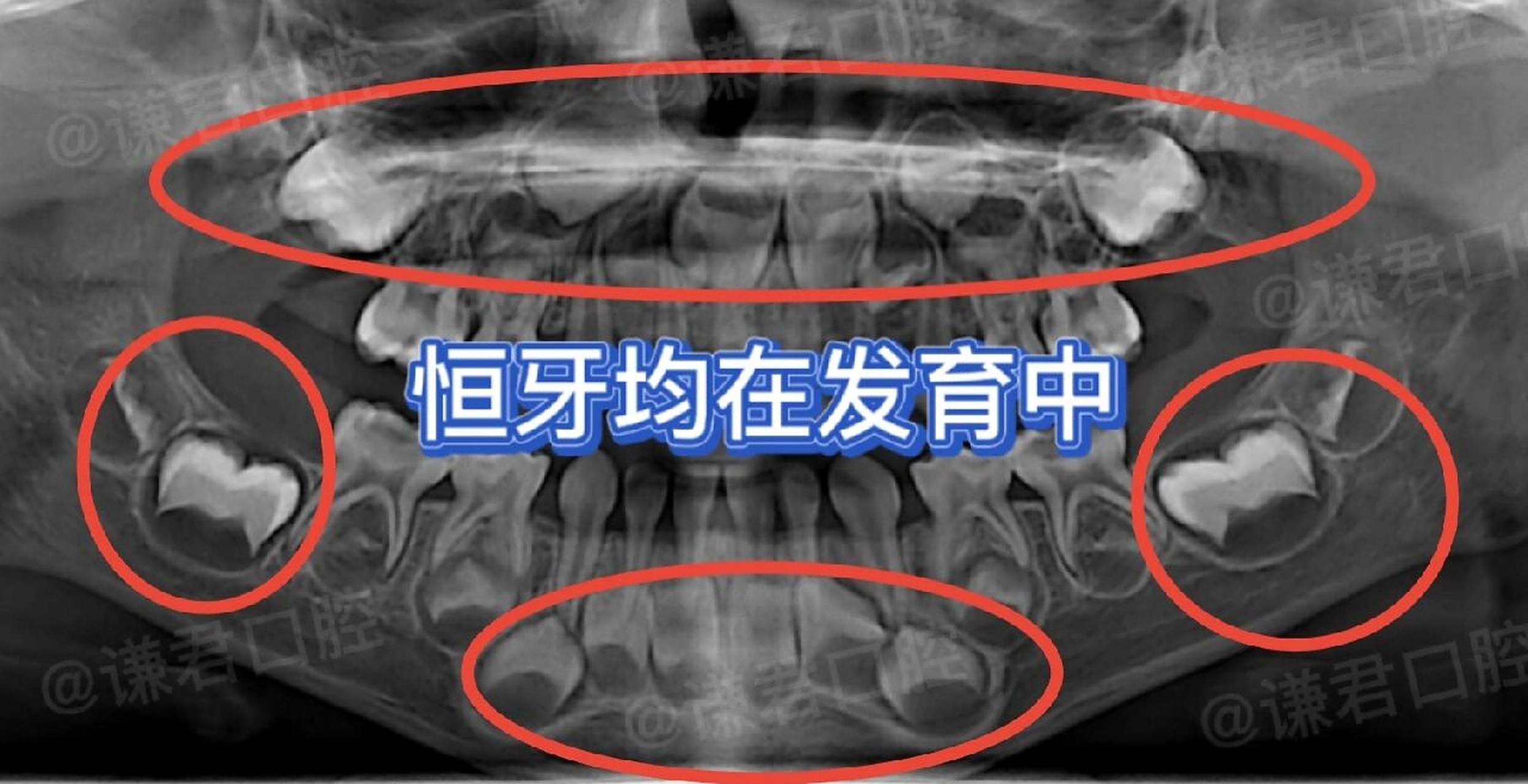 儿童乳牙治疗|牙片分析6015 图1: 左上门牙有龋坏,需要补牙.