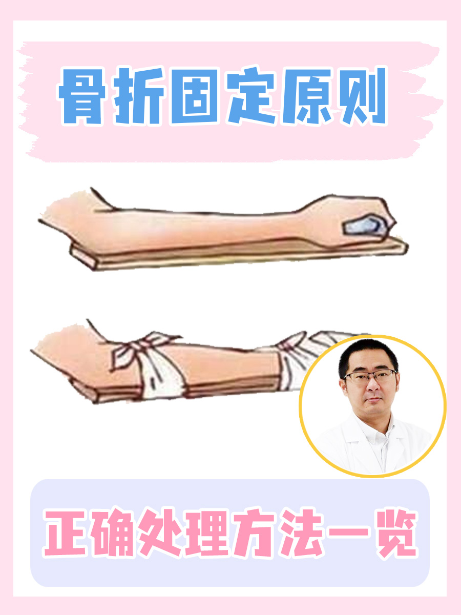 骨折固定原则,正确处理方法一览 骨折是生活中常见的一种意外伤害