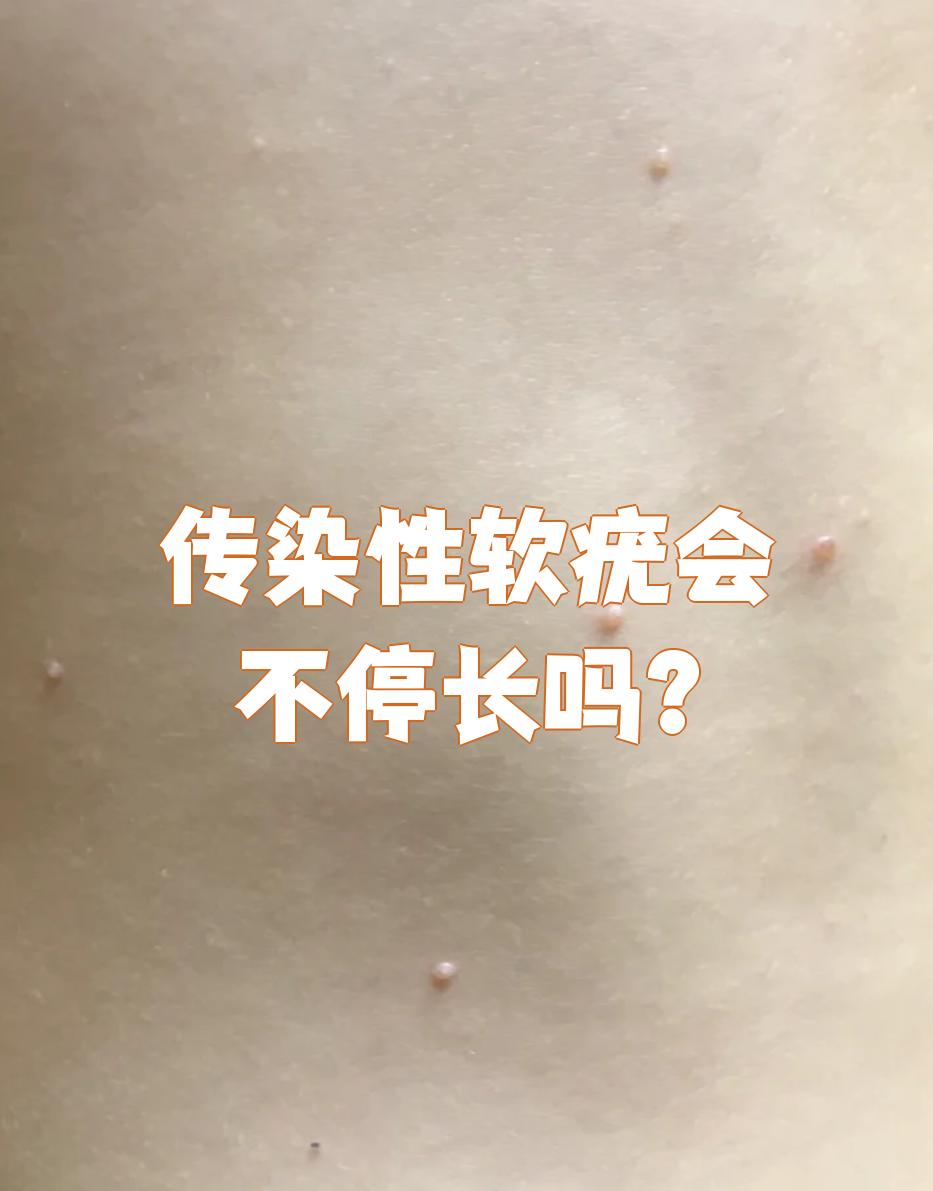 传染性软疣确实可能不停长,但及时治疗就能控制住