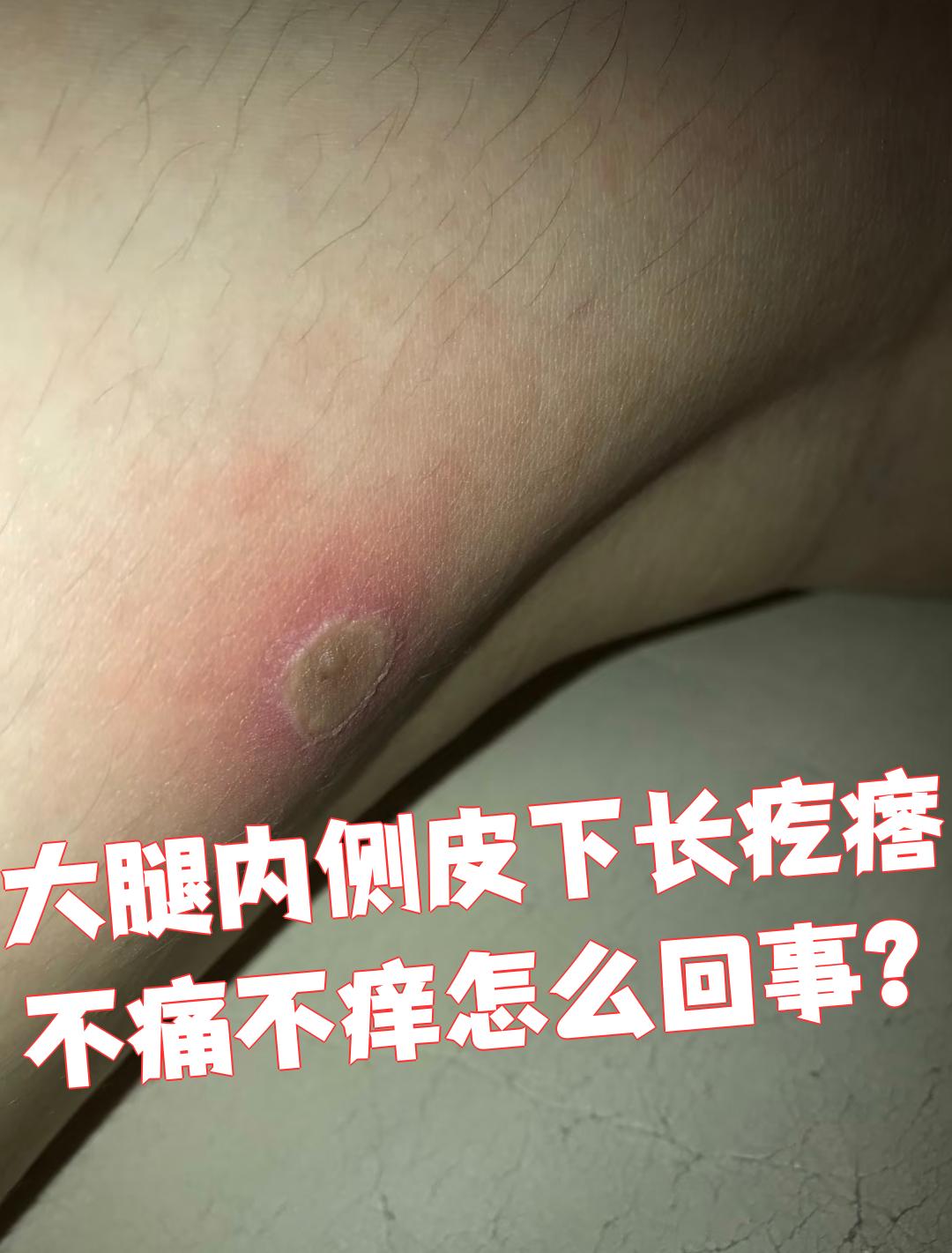 大腿内侧皮下长了一个不痛不痒的疙瘩,可能是由多种疾病引起的