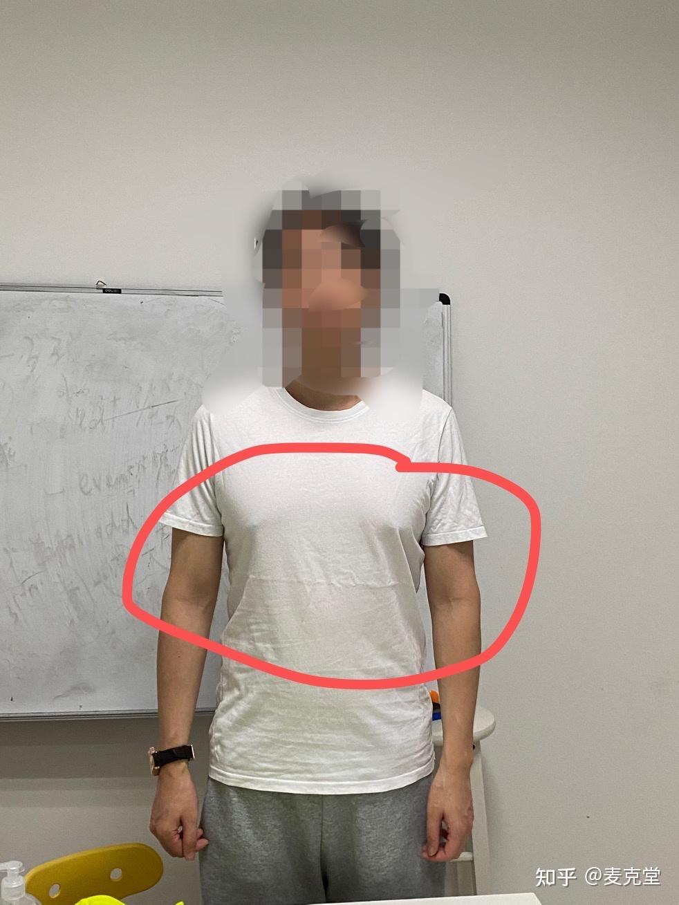 男性胸大胸部脂肪过多乳头尖尖乳房发育怎么办除锻炼改善以外可从外部