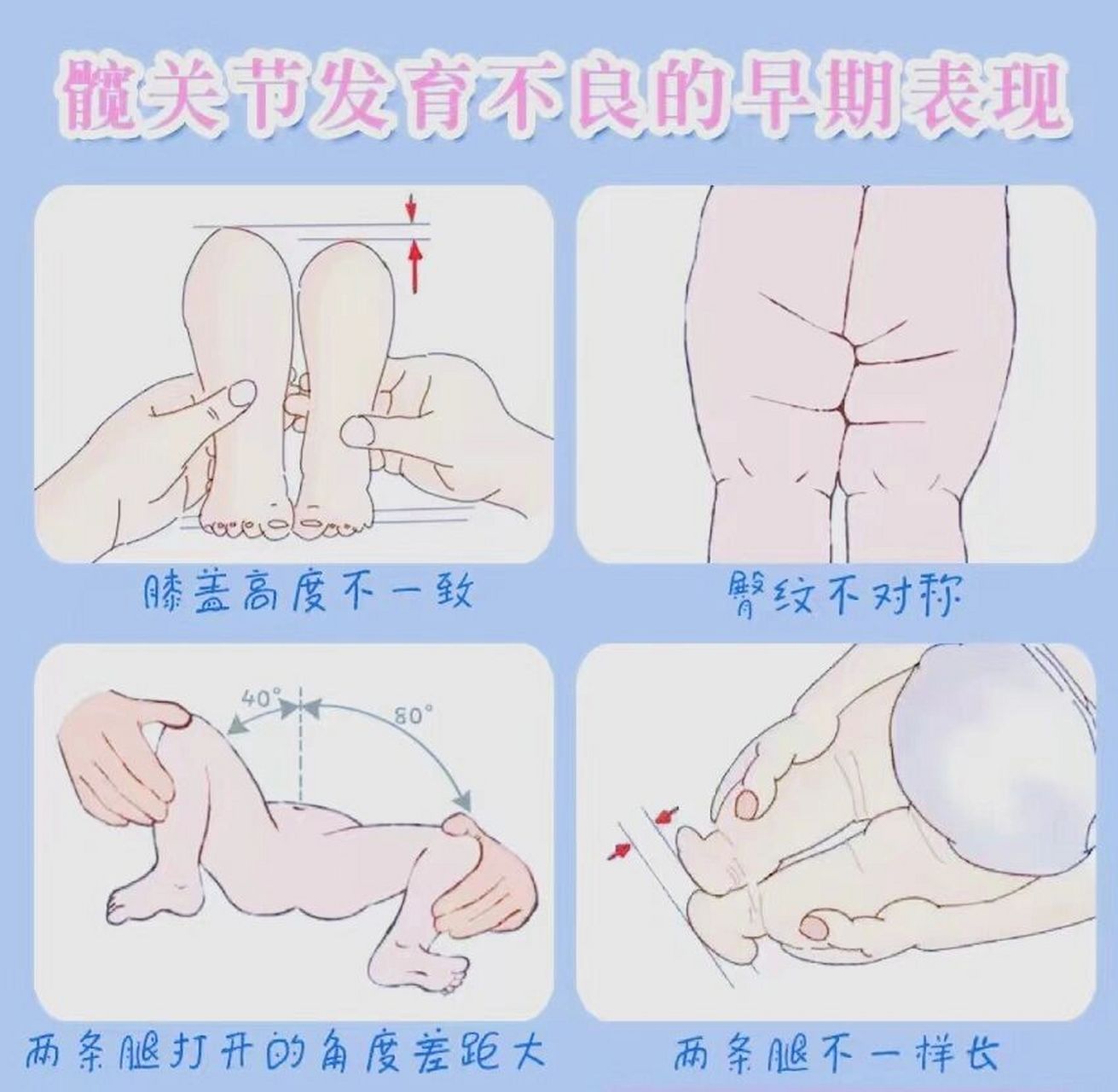 婴儿髋关节自测图图片