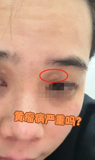 黄瘤病是因为脂质堆积在皮肤或肌腱里形成的黄色肿块