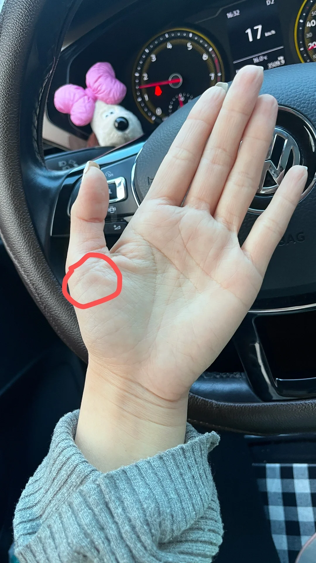 大鱼际肌肉萎缩,大拇指会无力,做了肌电图颈椎都没事,还要查什么,好烦