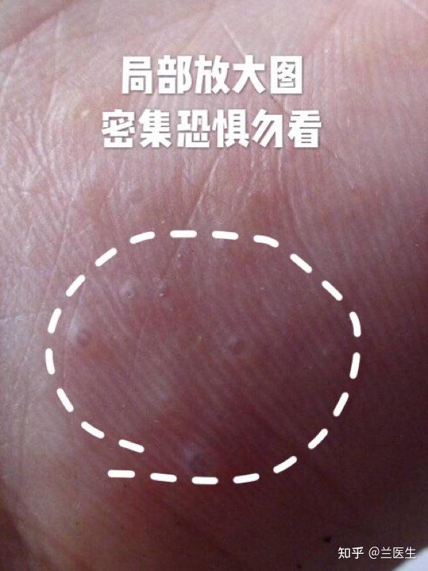 手指的指甲附近突然长了好几颗小水泡请问怎么回事