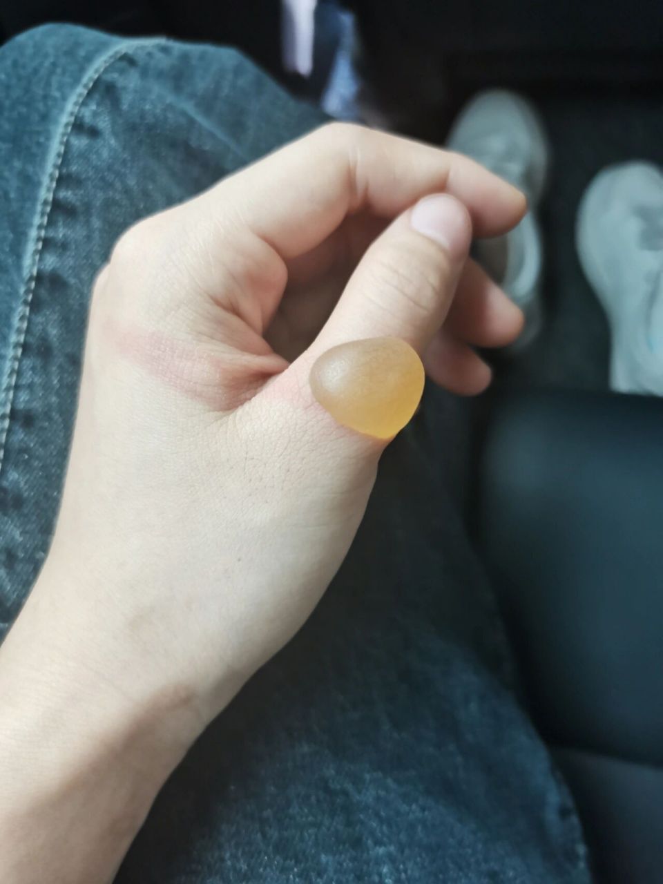 手背烫伤起泡了怎么办,要挑破吗 已经擦了烫伤药膏,原本没起泡,去洗了