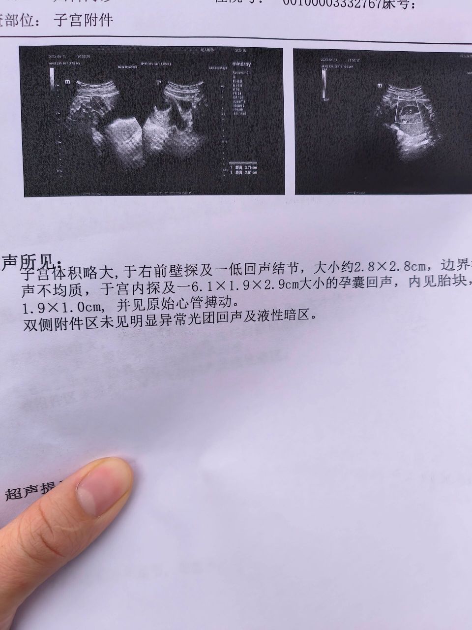 我的孕囊会不会太大 8周整  医生说没事  我看别的姐妹都没这么大  不
