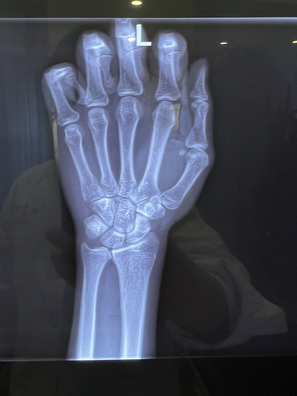 尺桡骨关节分离,手腕旋转疼痛 尺桡骨关节分离,导致手腕旋转疼痛.