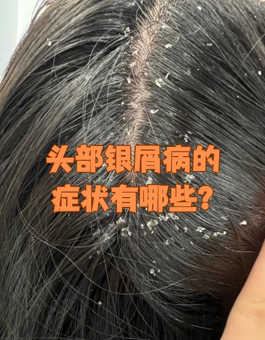 头部银屑病最明显的症状是头皮出现皮损,并产生大量鳞屑