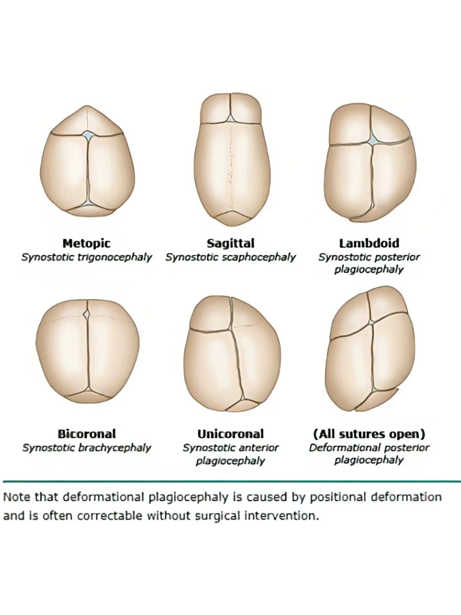 宝宝颅缝早闭怎么办?
