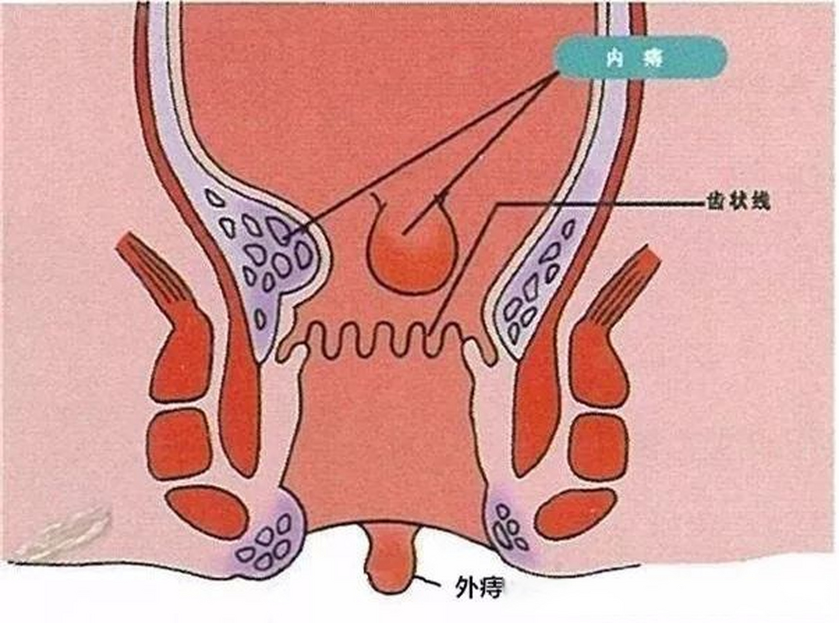 我们邢主任接诊一位女性因为便血痔疮脱出,排便不尽来院就诊.