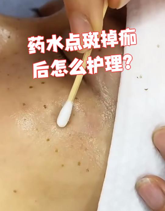 药水点斑掉痂后的护理很简单,主要注意三点:饮食,清洁和防晒