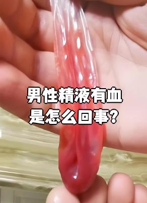 男性精液带血在医学上称为血精症,最常见的原因是前列腺炎,尿路感染