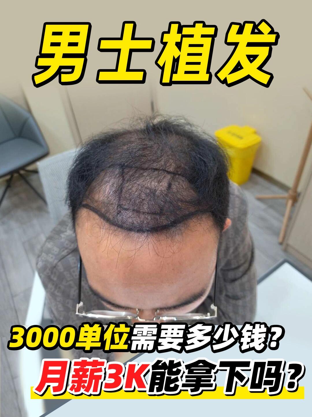 又省又香!男士植发3000毛囊单位就这个价