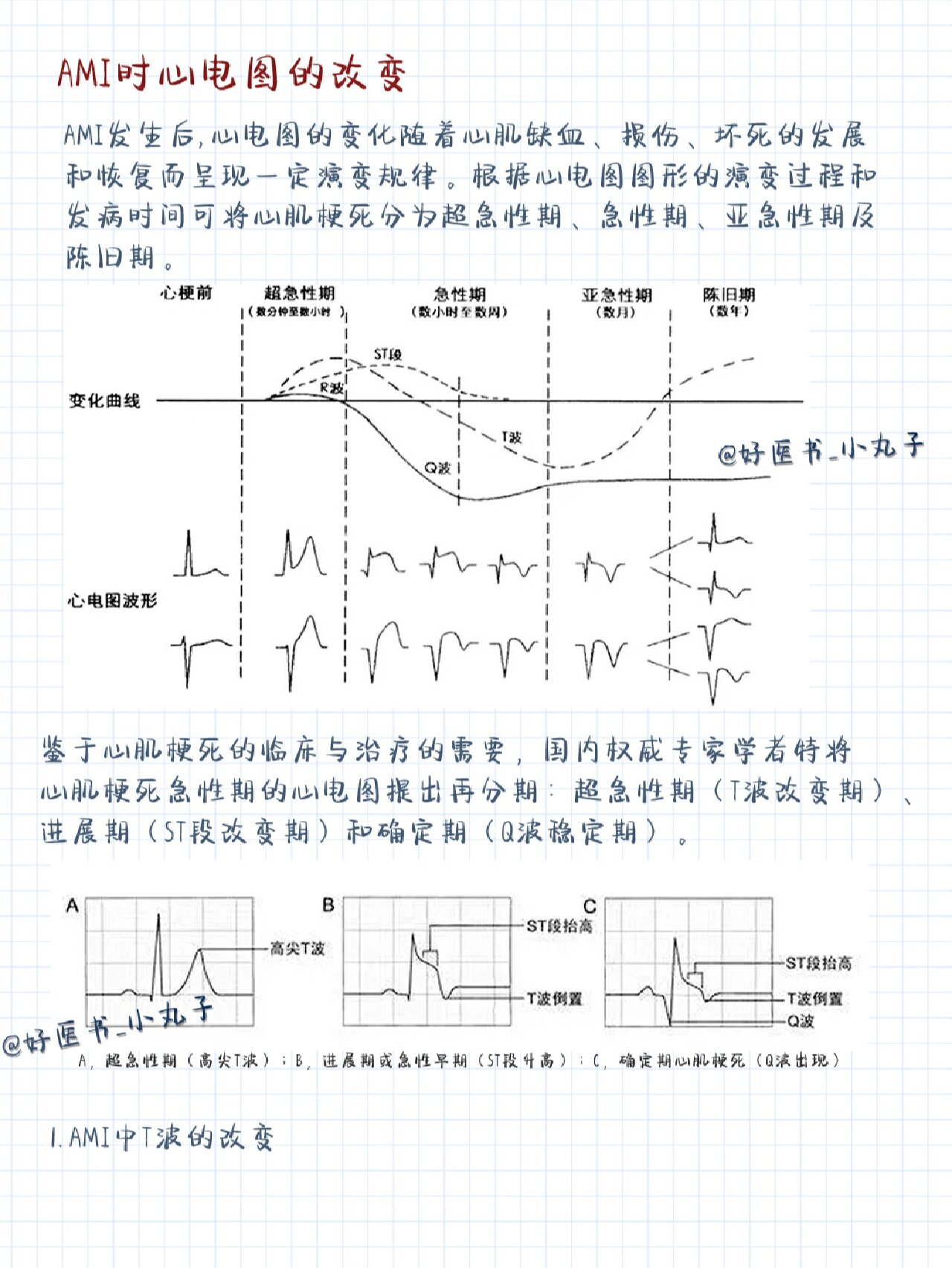 急性心梗心电图特点图片