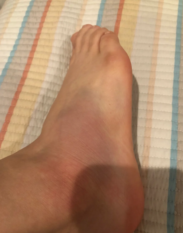 脚踝扭伤后肿胀一般需要2